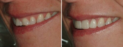 Results after dentistry at AH Smiles