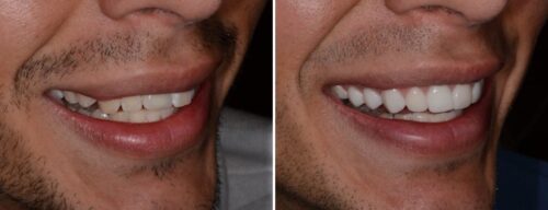 Results after dentistry at AH Smiles