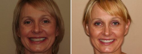 Results after dentistry at AH Smiles