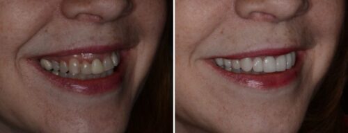 Results after dentistry at AH Smiles