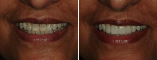 Results after dentistry at AH Smiles