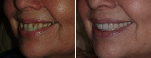 Results after dentistry at AH Smiles