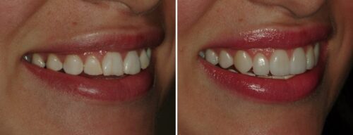 Results after dentistry at AH Smiles