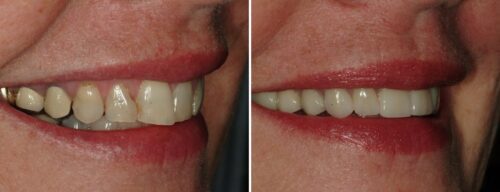 Results after dentistry at AH Smiles