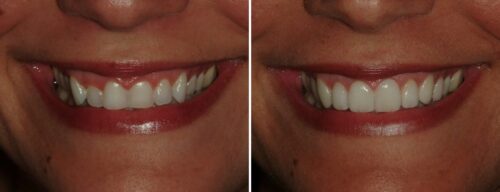 Results after dentistry at AH Smiles