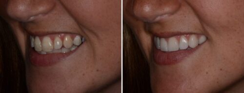 Results after dentistry at AH Smiles