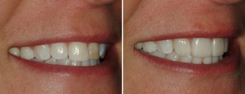 Results after dentistry at AH Smiles