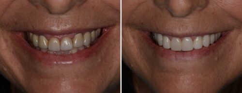 Results after dentistry at AH Smiles