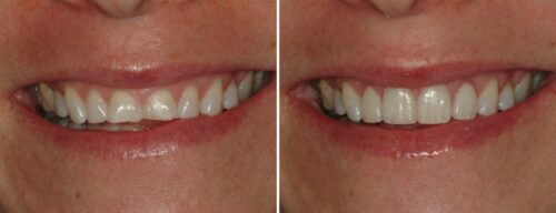 Results after dentistry at AH Smiles