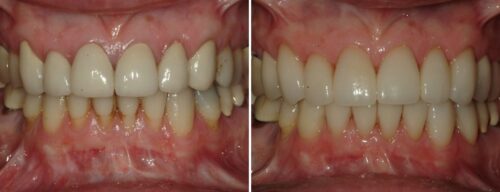 Results after dentistry at AH Smiles