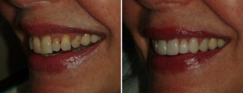 Results after dentistry at AH Smiles