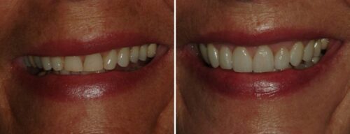 Results after dentistry at AH Smiles