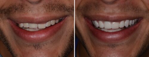 Results after dentistry at AH Smiles