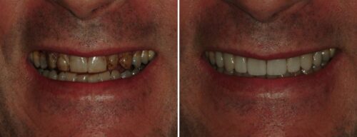 Results after dentistry at AH Smiles