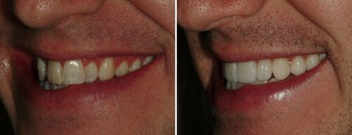 Results after dentistry at AH Smiles