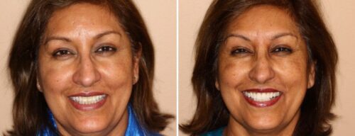 Results after dentistry at AH Smiles