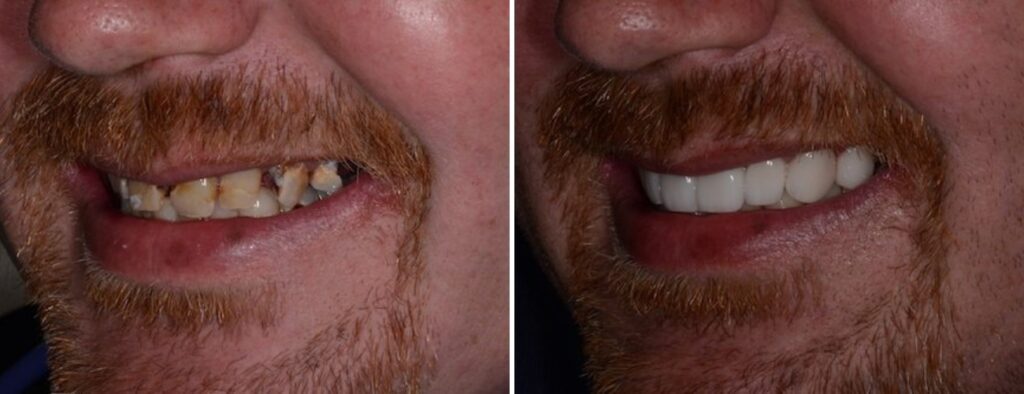 Patient before and after dental implants at AH Smiles