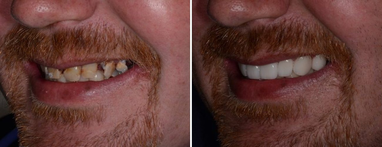 Patient before and after dental implants at AH Smiles