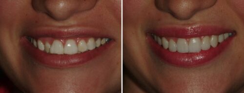 Results after dentistry at AH Smiles