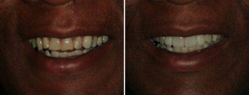 Results after dentistry at AH Smiles