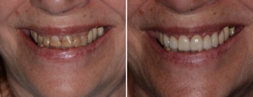 Results after dentistry at AH Smiles