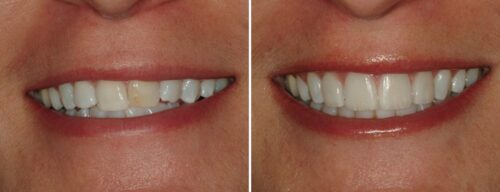 Results after dentistry at AH Smiles