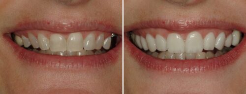 Results after dentistry at AH Smiles