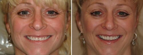 Results after dentistry at AH Smiles