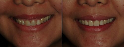 Results after dentistry at AH Smiles