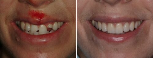 Results after dentistry at AH Smiles