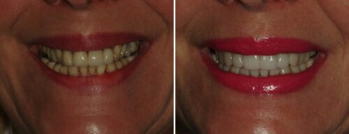 Results after dentistry at AH Smiles