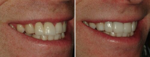 Results after dentistry at AH Smiles