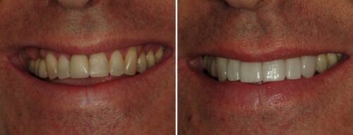 Results after dentistry at AH Smiles