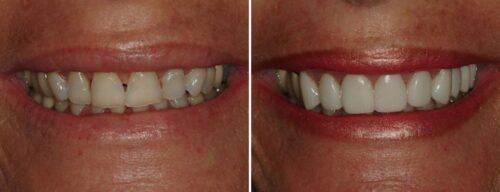 Results after dentistry at AH Smiles