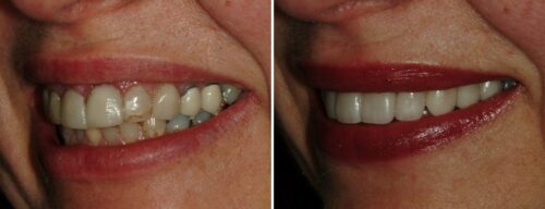 Results after dentistry at AH Smiles