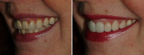 Results after dentistry at AH Smiles