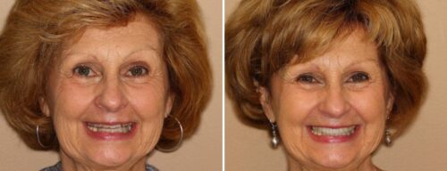 Results after dentistry at AH Smiles