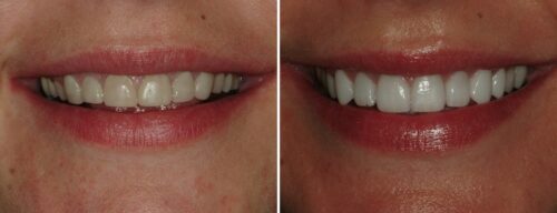 Results after dentistry at AH Smiles