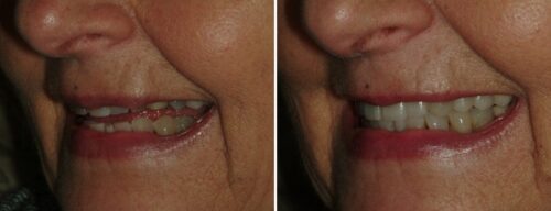 Results after dentistry at AH Smiles