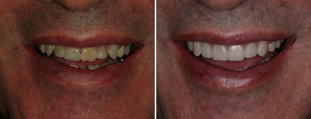 Dental patient before and after dental restorations at AH Smiles