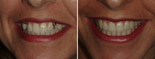 Results after dentistry at AH Smiles