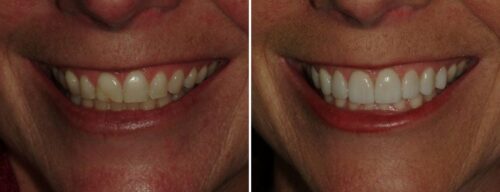 Results after dentistry at AH Smiles