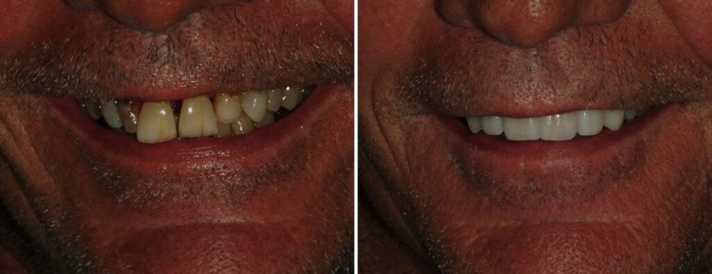 Patient before and after dental implants at AH Smiles