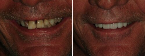 Results after dentistry at AH Smiles