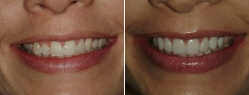 Results after dentistry at AH Smiles