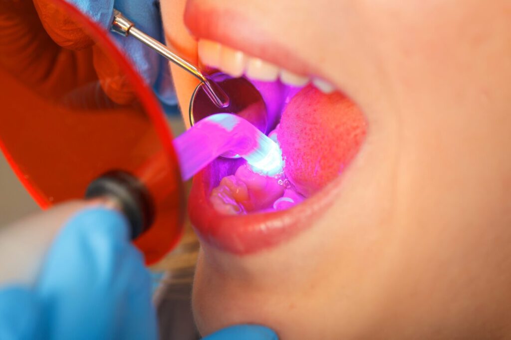 dental bonding in Arlington Heights, IL