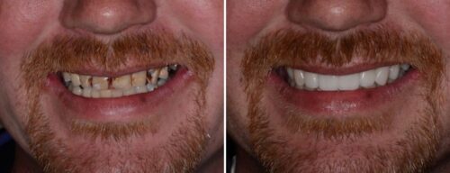 Results after dentistry at AH Smiles