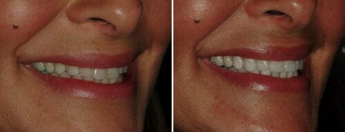 Results after dentistry at AH Smiles