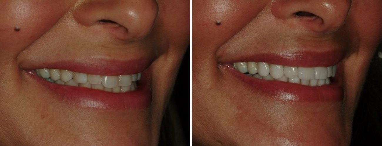 Dental patient before and after dentistry