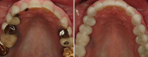 Results after dentistry at AH Smiles